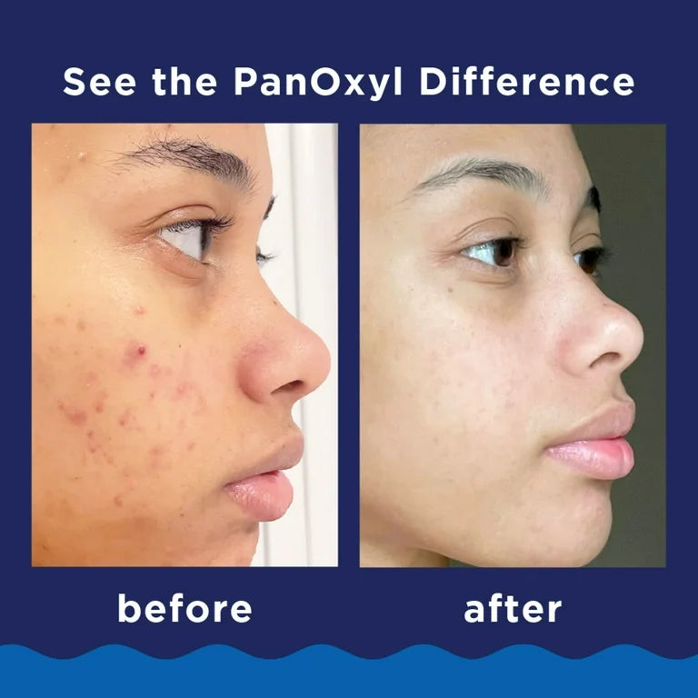 PanOxyl Maximum Strength Antimicrobial Acne Foaming Wash for Face