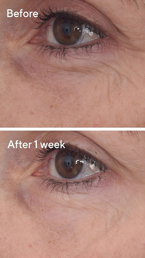 Retinal ReSculpt Eye Lift Treatment