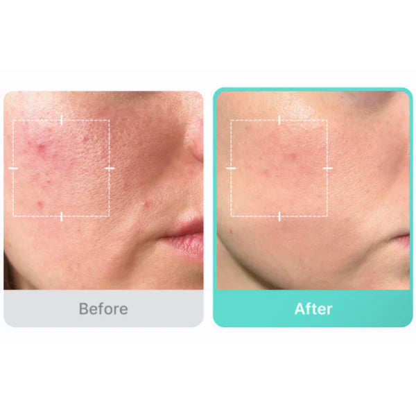 Azelaic Acid 16 BB Soothing Serum