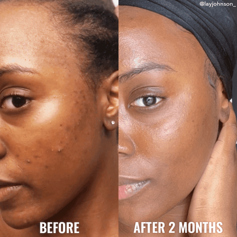 Blemish Scar & Discoloration Duo